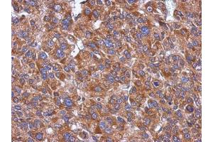 IHC-P Image Immunohistochemical analysis of paraffin-embedded human hepatoma, using CYP26A1 , antibody at 1:500 dilution. (CYP26A1 Antikörper  (Center))
