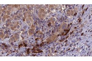 ABIN6277103 at 1/100 staining Human liver cancer tissue by IHC-P. (SPAM1 Antikörper  (Internal Region))