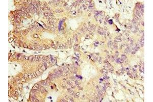 Immunohistochemistry of paraffin-embedded human colon cancer using ABIN7149378 at dilution of 1:100 (ACOT7 Antikörper  (AA 151-380))