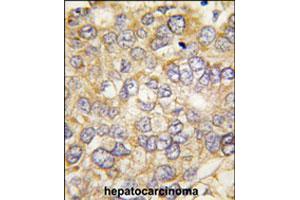 Formalin-fixed and paraffin-embedded human hepatocellular carcinoma reacted with CHRD polyclonal antibody  , which was peroxidase-conjugated to the secondary antibody, followed by DAB staining. (Chordin Antikörper  (C-Term))