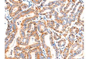 The image on the left is immunohistochemistry of paraffin-embedded Human thyroid cancer tissue using ABIN7192286(SCNN1A Antibody) at dilution 1/30, on the right is treated with synthetic peptide. (SCNN1A Antikörper)