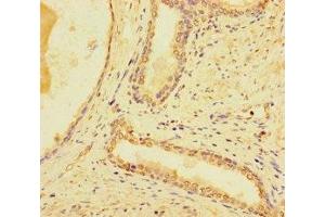 Immunohistochemistry of paraffin-embedded human prostate cancer using ABIN7171154 at dilution of 1:100 (SYT1 Antikörper  (AA 301-523))