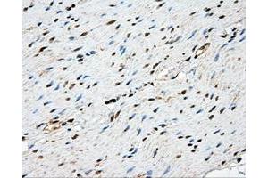 Immunohistochemical staining of paraffin-embedded Adenocarcinoma of ovary tissue using anti-NME4 mouse monoclonal antibody. (NME4 Antikörper)