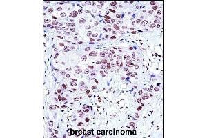 NCK1 Antibody (N-term) (ABIN657648 and ABIN2846643) immunohistochemistry analysis in formalin fixed and paraffin embedded human breast carcinoma followed by peroxidase conjugation of the secondary antibody and DAB staining.