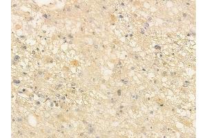 ABIN6260980 and ABIN6266518 at 1/100 staining human astrocytoma by IHC-P.