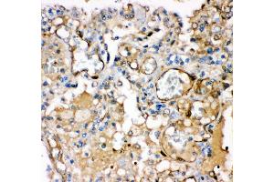 Anti- KCNMA1antibody,IHC(P) IHC(P): Human Lung Cancer Tissue