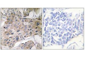 Immunohistochemistry analysis of paraffin-embedded human breast carcinoma tissue using COX7S/A2 antibody. (COX7S/A2 (N-Term) Antikörper)