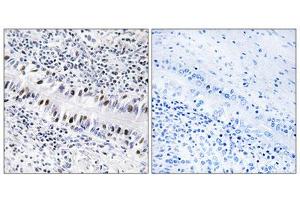 Immunohistochemistry analysis of paraffin-embedded human lung carcinoma tissue, using ZNF76 antibody. (ZNF76 Antikörper  (Internal Region))