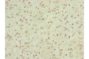 Immunohistochemistry of paraffin-embedded human glioma using ABIN7152447 at dilution of 1:100