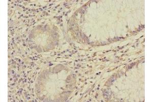 Immunohistochemistry of paraffin-embedded human colon cancer using ABIN7170966 at dilution of 1:100 (SAE1 Antikörper  (AA 1-346))