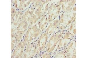 Immunohistochemistry of paraffin-embedded human gastric cancer using ABIN7151422 at dilution of 1:100 (EFHC1 Antikörper  (AA 391-640))