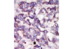 Formalin-fixed and paraffin-embedded human cancer tissue reacted with the primary antibody, which was peroxidase-conjugated to the secondary antibody, followed by DAB staining. (PDK2 Antikörper  (C-Term))