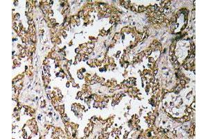 Immunohistochemical analysis of paraffin-embedded human lung cancer tissue using OR5H15 polyclonal antibody . (OR5H15 Antikörper)