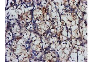 Immunohistochemical staining of paraffin-embedded Carcinoma of Human kidney tissue using anti-MGLL mouse monoclonal antibody. (MGLL Antikörper)