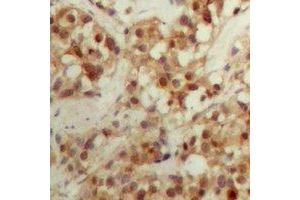 Immunohistochemical analysis of CBFB staining in human breast cancer formalin fixed paraffin embedded tissue section. (CBFB Antikörper  (N-Term))