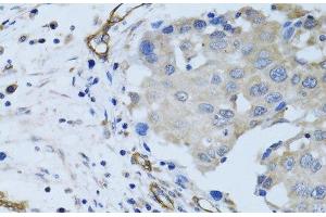 Immunohistochemistry of paraffin-embedded Human breast cancer using MCAM Polyclonal Antibody at dilution of 1:100 (40x lens). (MCAM Antikörper)