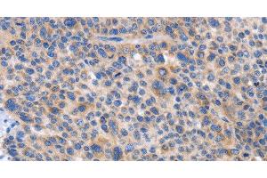 Immunohistochemistry of paraffin-embedded Human liver cancer tissue using CARD17 Polyclonal Antibody at dilution 1:50 (CARD17 Antikörper)