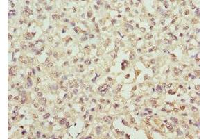 Immunohistochemistry of paraffin-embedded human melanoma using ABIN7143939 at dilution of 1:100 (SNCA Antikörper  (AA 1-139))