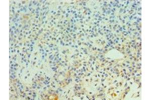 Immunohistochemistry of paraffin-embedded human breast cancer using ABIN7147302 at dilution of 1:100 (CDC16 Antikörper  (AA 371-620))