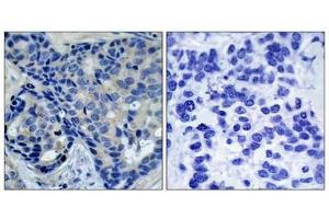 Immunohistochemical analysis of paraffin-embedded human breast carcinoma tissue using Pyk2(Phospho-Tyr402) Antibody(left) or the same antibody preincubated with blocking peptide(right). (PTK2B Antikörper  (pTyr402))