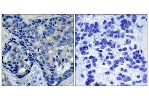 Immunohistochemical analysis of paraffin-embedded human breast carcinoma tissue using Pyk2(Phospho-Tyr402) Antibody(left) or the same antibody preincubated with blocking peptide(right).