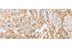 Immunohistochemistry of paraffin-embedded Human thyroid cancer tissue using HBZ Polyclonal Antibody at dilution of 1:120(x200) (HBZ Antikörper)