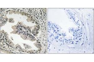 Immunohistochemistry analysis of paraffin-embedded human prostate carcinoma tissue, using SH3GLB2 Antibody. (SH3GLB2 Antikörper  (AA 131-180))