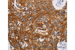 Immunohistochemistry of Human liver cancer using GRIN1 Polyclonal Antibody at dilution of 1:45 (GRIN1/NMDAR1 Antikörper)