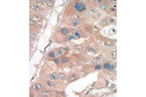 Formalin-fixed and paraffin-embedded human cancer tissue reacted with the primary antibody, which was peroxidase-conjugated to the secondary antibody, followed by DAB staining. (p21 Antikörper  (C-Term))