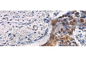 Immunohistochemistry of paraffin-embedded Human esophagus cancer tissue using SORD Polyclonal Antibody at dilution of 1:45(x200) (SORD Antikörper)
