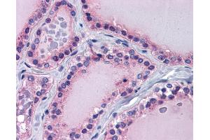 Immunohistochemistry (IHC) image for anti-Paired Box 8 (PAX8) (Middle Region) antibody (ABIN2775952) (PAX8 Antikörper  (Middle Region))