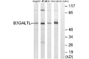 Immunohistochemistry analysis of paraffin-embedded human liver carcinoma tissue using B3GALTL antibody. (B3GALTL Antikörper)