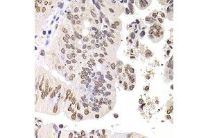 Immunohistochemistry of paraffin-embedded human colon carcinoma using SOX5 antibody at dilution of 1:100 (x400 lens). (SOX5 Antikörper)
