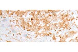 Immunohistochemistry of paraffin-embedded Human colorectal cancer tissue using MOB1B Polyclonal Antibody at dilution of 1:25(x200) (MOBKL1A Antikörper)