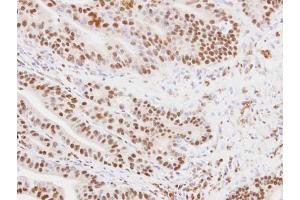 IHC-P Image Immunohistochemical analysis of paraffin-embedded PC14 xenograft, using MKRN1, antibody at 1:100 dilution. (MKRN1 Antikörper)