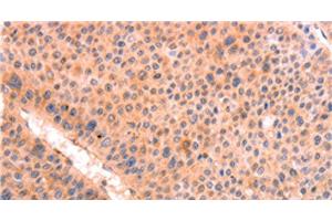Immunohistochemistry of paraffin-embedded Human liver cancer tissue using LEP Polyclonal Antibody at dilution 1:30 (Leptin Antikörper)