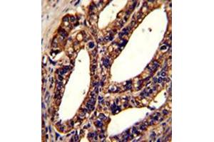 Formalin-fixed and paraffin-embedded human prostate carcinoma reacted with ORAI1 Antibody (Center) followed which was peroxidase-conjugated to the secondary antibody, followed by DAB staining.