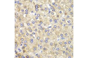 Immunohistochemistry of paraffin-embedded human liver cancer using HADH antibody (ABIN5970434) at dilution of 1/100 (40x lens). (HADH Antikörper)
