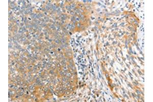 The image on the left is immunohistochemistry of paraffin-embedded Human cervical cancer tissue using ABIN7128369(ALPI Antibody) at dilution 1/25, on the right is treated with fusion protein. (Intestinal Alkaline Phosphatase Antikörper)