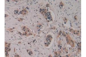Detection of CASP4 in Human Breast cancer Tissue using Polyclonal Antibody to Caspase 4 (CASP4) (Caspase 4 Antikörper  (AA 290-377))