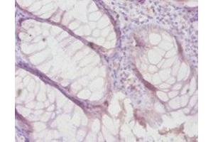 Immunohistochemistry of paraffin-embedded human colon cancer using ABIN7159497 at dilution of 1:100 (TIMP4 Antikörper  (AA 31-224))