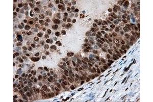 Immunohistochemical staining of paraffin-embedded Adenocarcinoma of breast tissue using anti-LTA4H mouse monoclonal antibody.