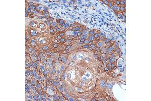 Immunohistochemistry of paraffin-embedded human esophageal cancer using BCL2L12 Rabbit mAb (ABIN7265864) at dilution of 1:100 (40x lens). (BCL2L12 Antikörper)