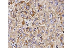Immunohistochemistry of paraffin-embedded Human liver cancer using GAS2 Polyclonal Antibody at dilution of 1:200 (40x lens). (GAS2 Antikörper)