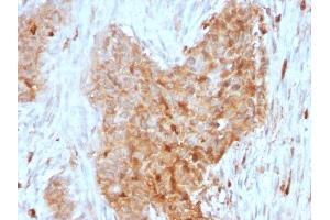 Formalin-fixed, paraffin-embedded human Breast Carcinoma stained with GPI Mouse Monoclonal Antibody (CPTC-GPI-1). (GPI Antikörper)