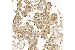 Immunohistochemistry of paraffin-embedded human lung cancer using Na+/K+-ATPase Rabbit pAb (ABIN6133568, ABIN6137299, ABIN6137301 and ABIN6223860) at dilution of 1:50 (40x lens). (ATP1A1 Antikörper  (AA 1-100))