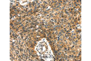 Immunohistochemistry of Human esophagus cancer using PRSS50 Polyclonal Antibody at dilution of 1:30