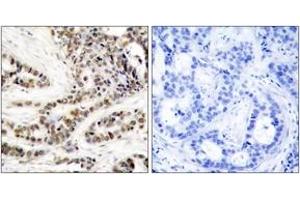 Immunohistochemistry analysis of paraffin-embedded human breast carcinoma, using CREB (Phospho-Ser129) Antibody. (CREB1 Antikörper  (pSer129))