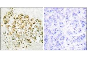Immunohistochemistry analysis of paraffin-embedded human breast carcinoma tissue, using MZF-1 Antibody.