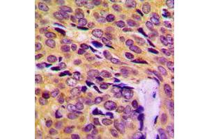 Immunohistochemical analysis of MRPL14 staining in human breast cancer formalin fixed paraffin embedded tissue section. (MRPL14 Antikörper  (C-Term))